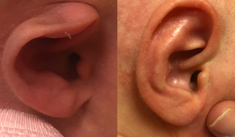 Ear Deformities in Newborns and Ear Molding