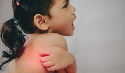 5 Tips to Prevent a Child’s Heat Rash
