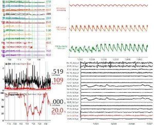 Real Analysis for Multimodal Monitoring