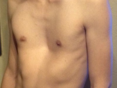 Photo of a teen's sunken chest